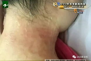 女生美容院拔罐后变紫薯精？真相究竟如何？